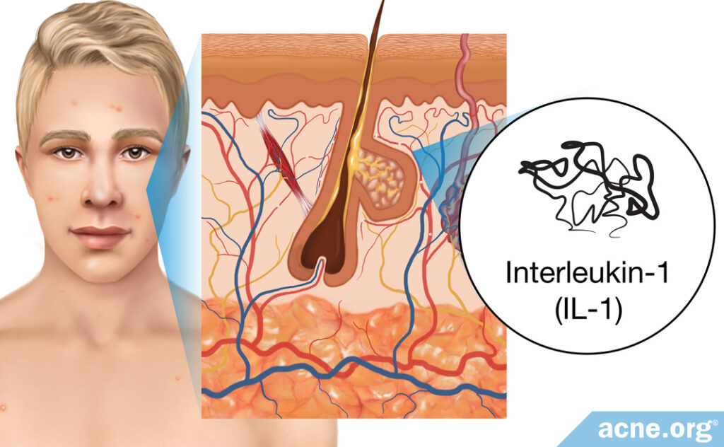 Interleukin-1 (IL-1) in the Skin