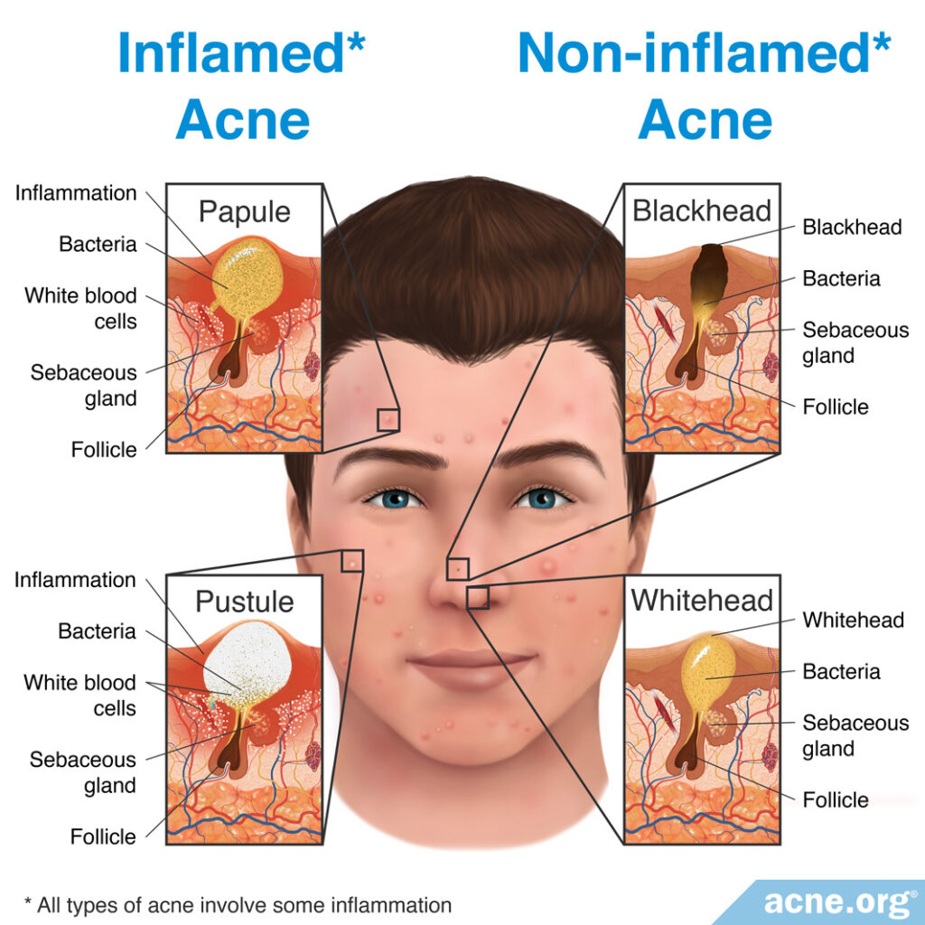 Inflamed Acne vs. Non-inflamed Acne