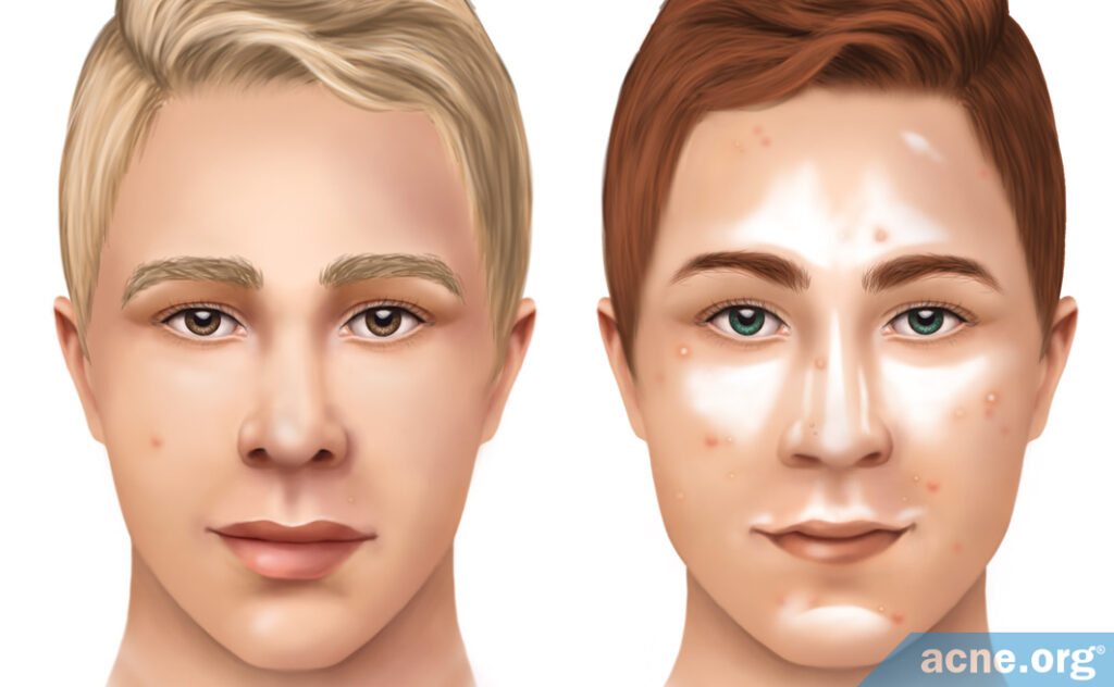 Sebum Levels in Acne Patients