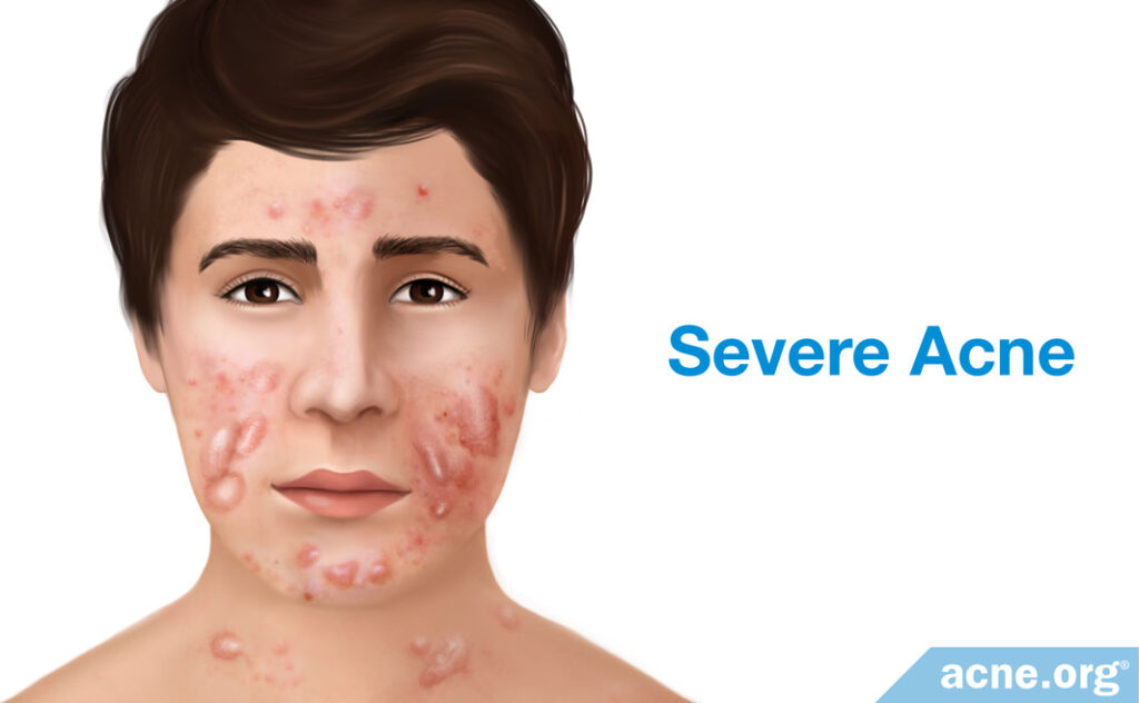 Severe Acne