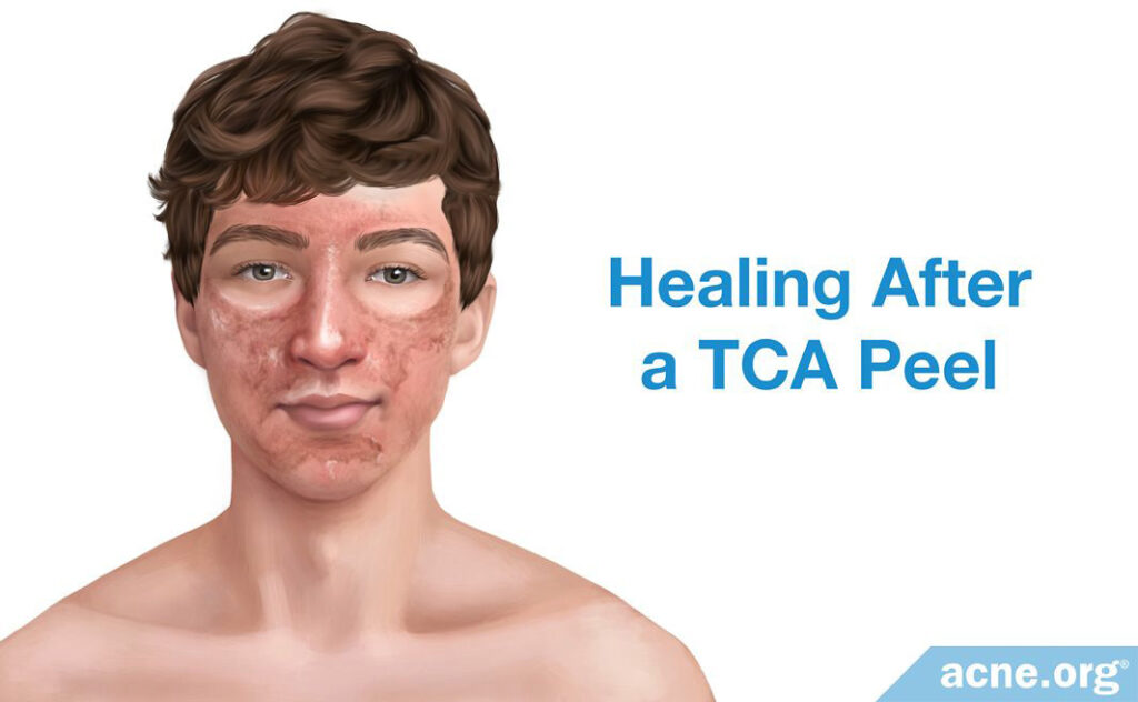 Healing After a TCA Peel