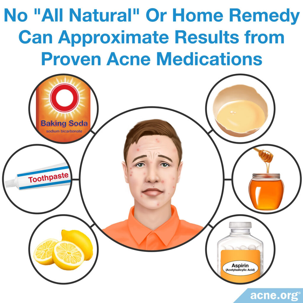 Acne Home Remedies