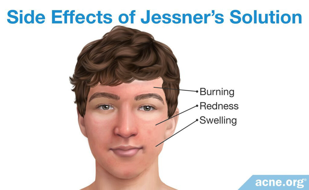 Side Effects of Jessner's Solution