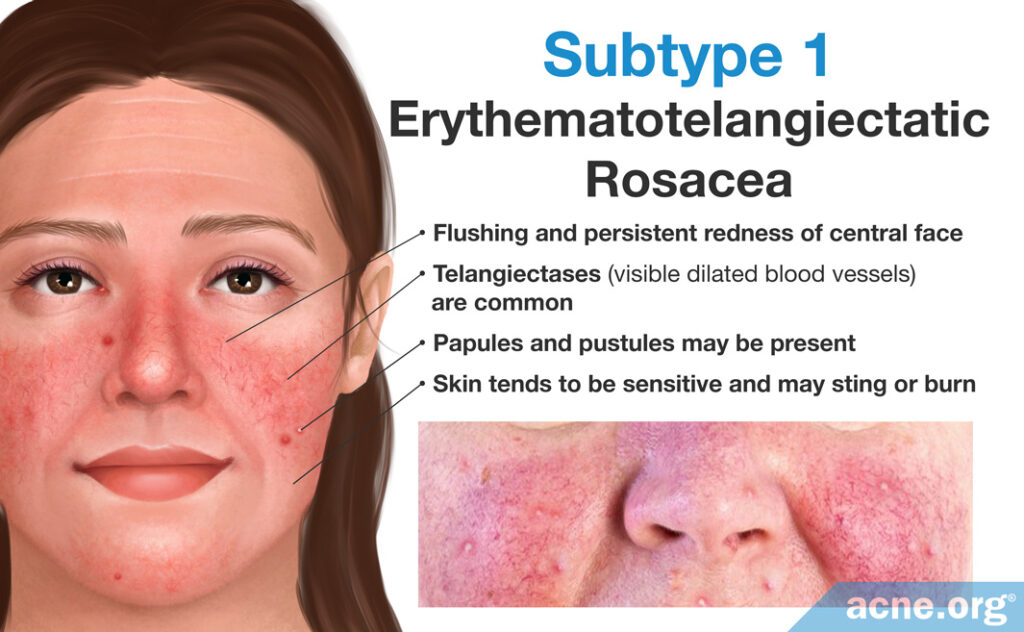 Subtype 1: Erythematotelangiectatic Rosacea