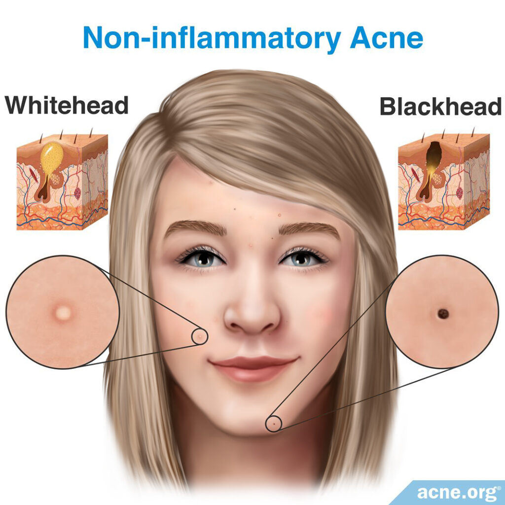 Non-inflammatory Acne