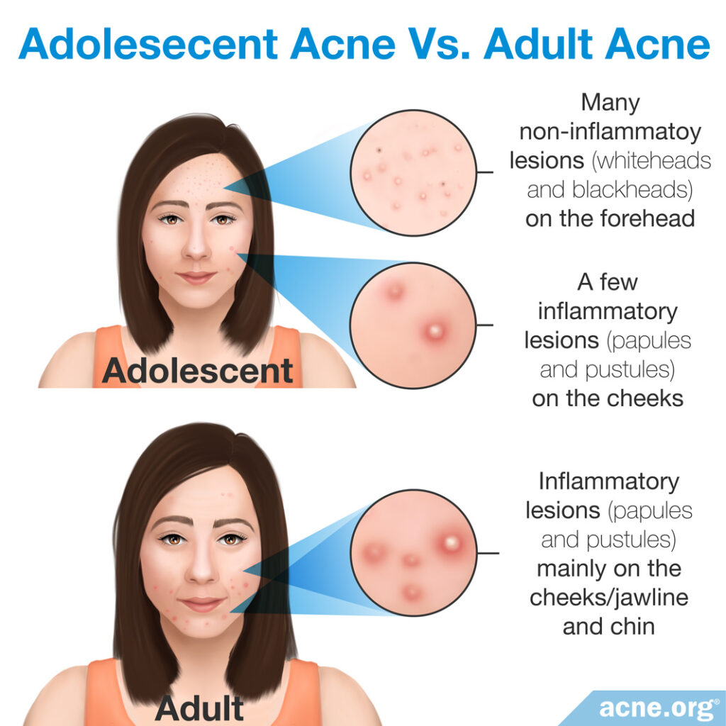 Adolescent Acne vs. Adult Acne