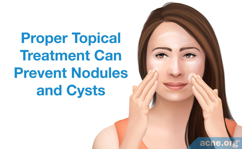 Proper Topical Treatment Can Prevent Nodules and Cysts