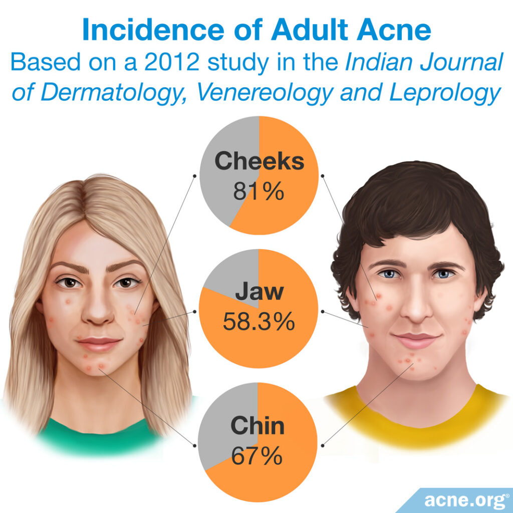 Incidence of Adult Acne on Cheeks, Chin and Jaw Area