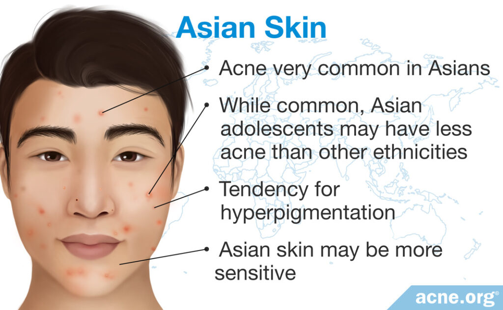 Asian Skin and Acne