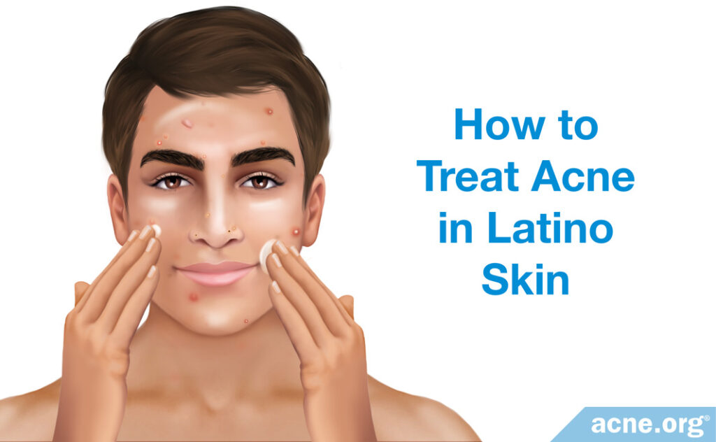 How to Treat Acne in Latino Skin