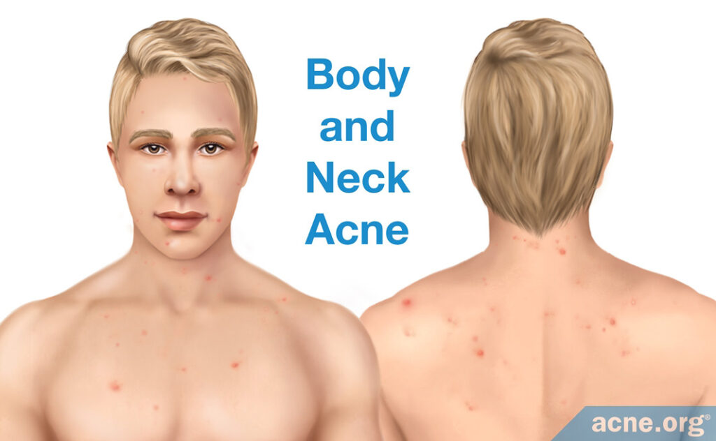 Body and Neck Acne