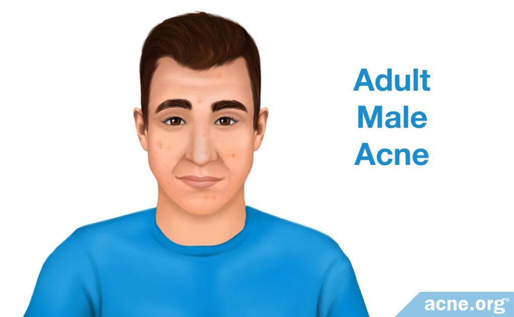 Adult Male Acne