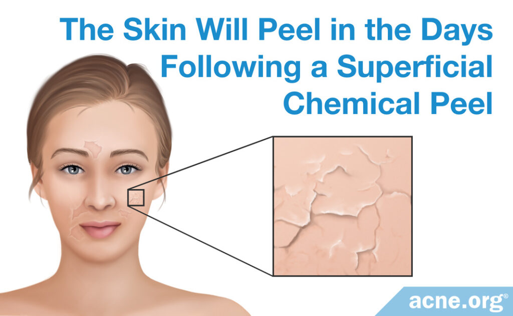 The Skin Will Peel in the Days Following a Superficial Chemical Peel