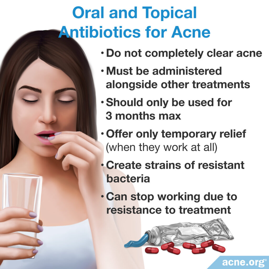 Oral and Topical Antibiotics for Acne