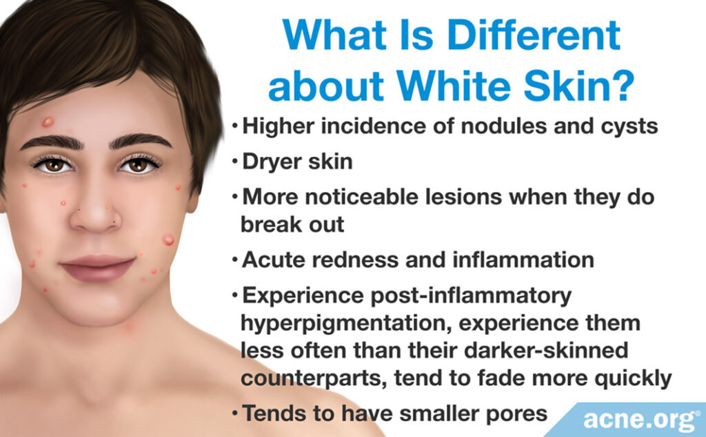 What Is Different about White Skin?
