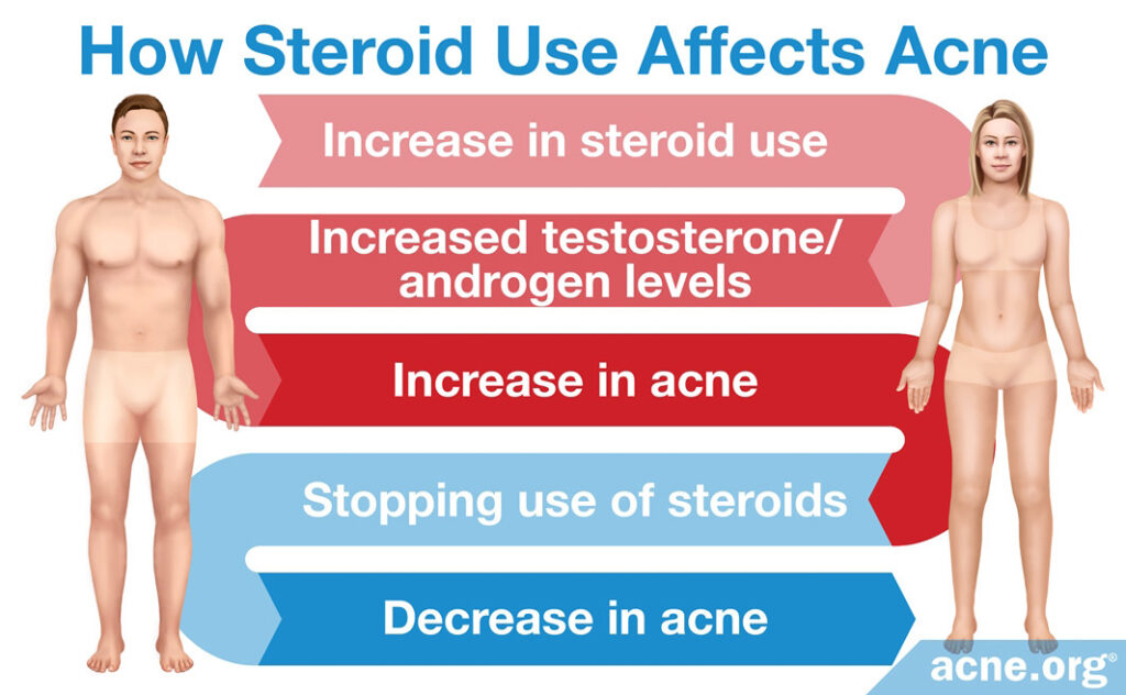 How Steroid Use Affects Acne