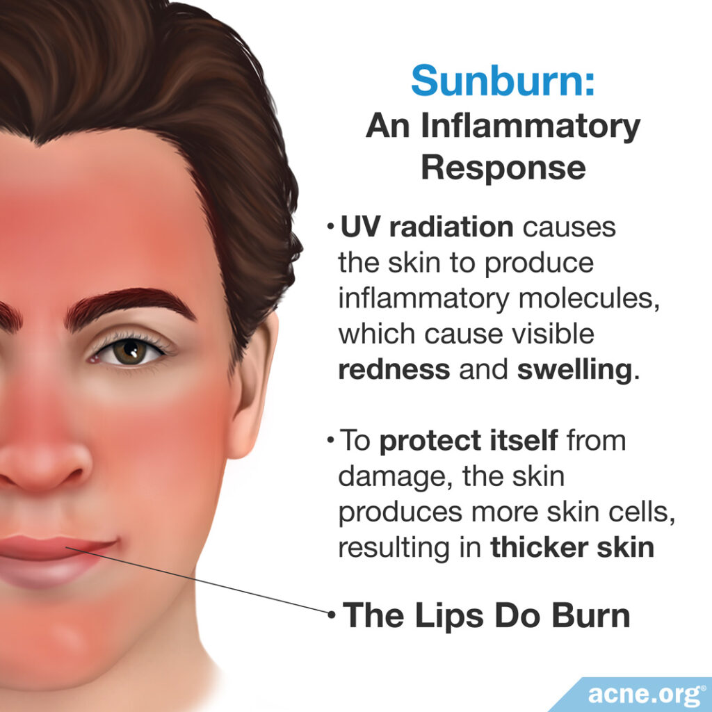 Sunburn: An Inflammatory Response