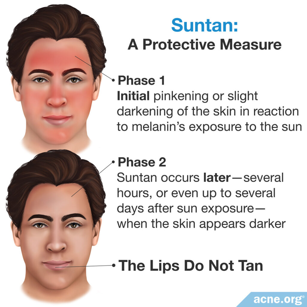 Suntan: A Protective Measure