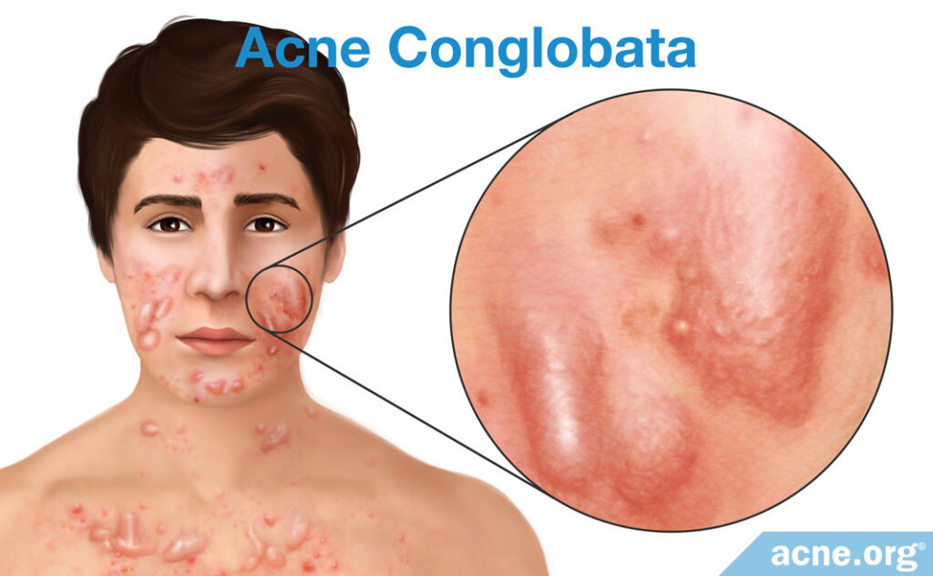 Acne conglobata