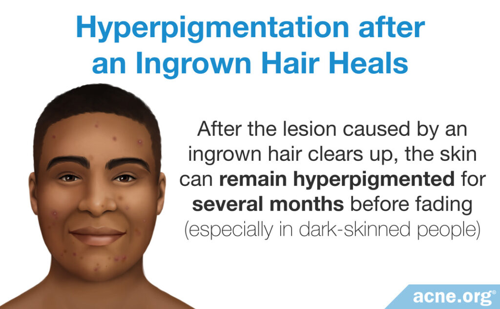 Hyperpigmentation after an Ingrown Hair Heals