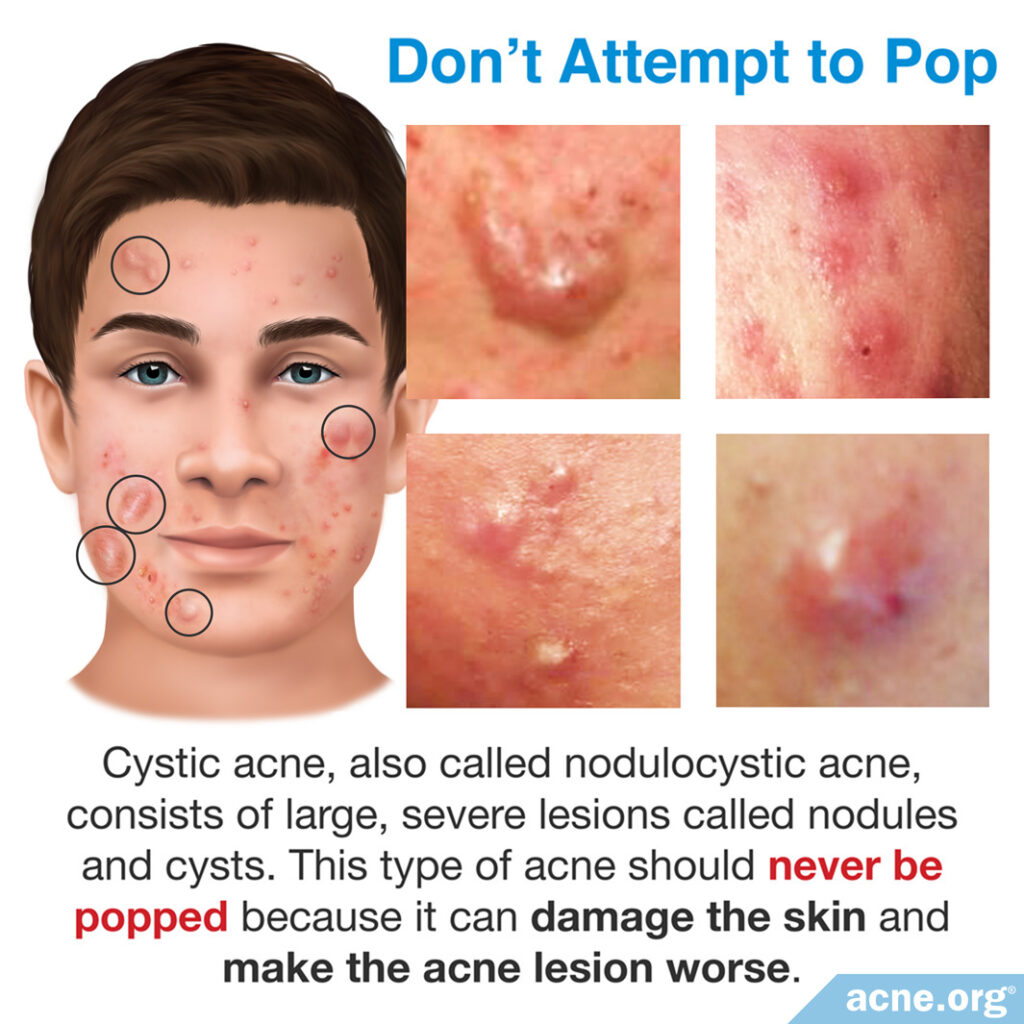 Cystic Acne Should Never Be Popped