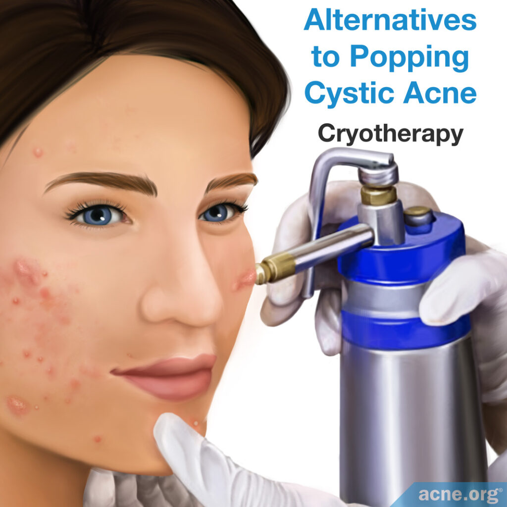 Alternatives to Popping Cystic Acne - Cryotherapy