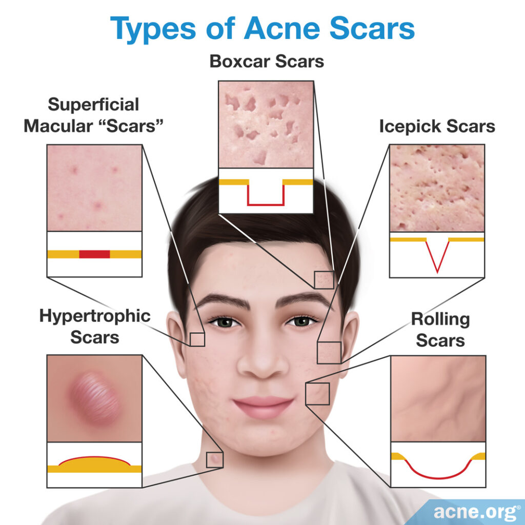 Types of Acne Scars