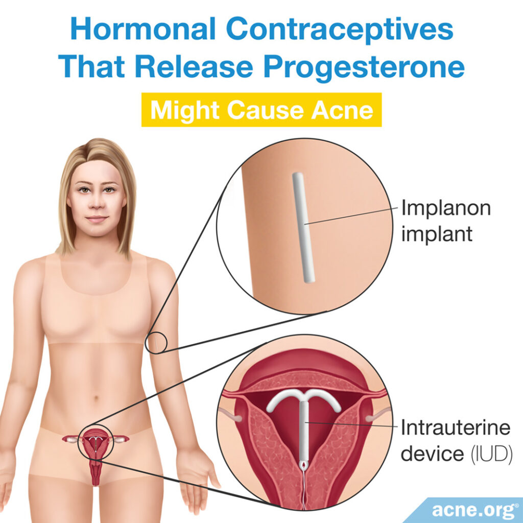 Hormonal Contraceptives That Release Progesterone Might Cause Acne