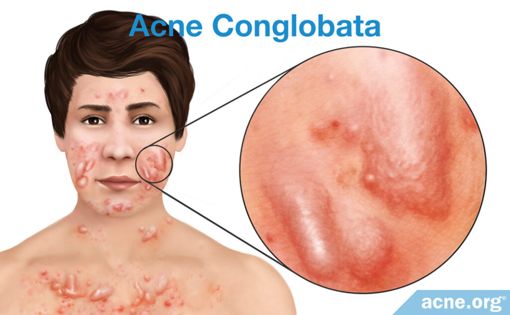 Acne Conglobata