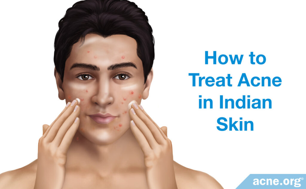 How to Treat Acne in Indian Skin