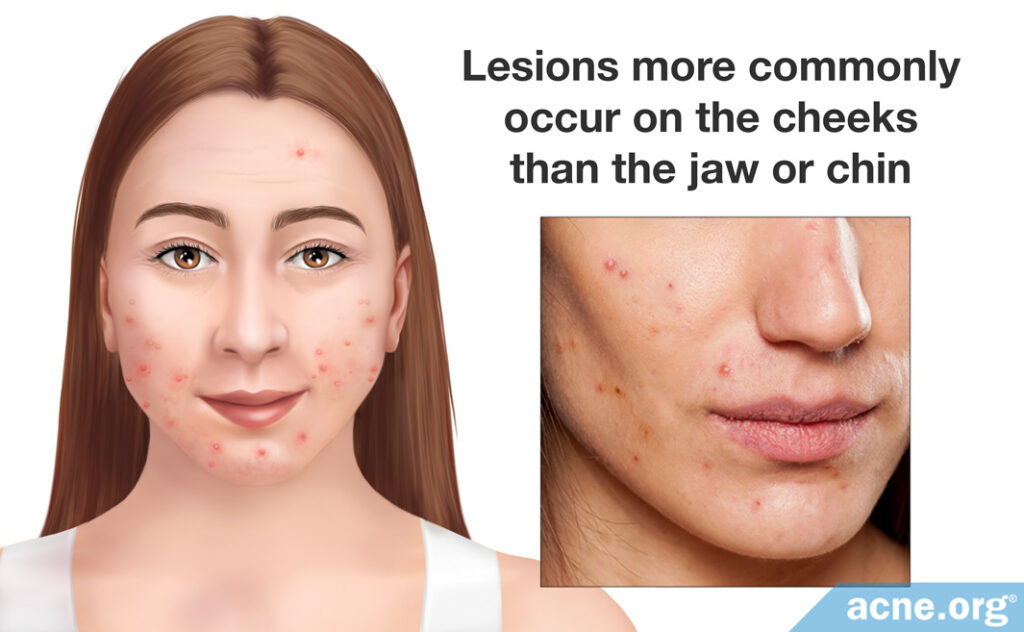 Common locations of adult female acne
