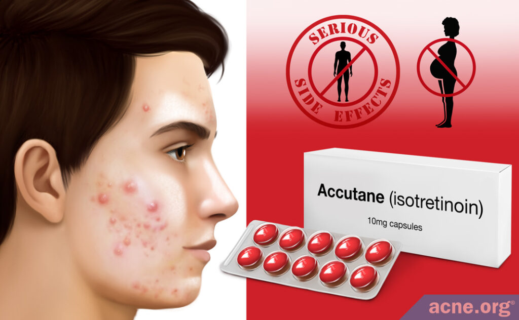 Accutane Isotretinoin