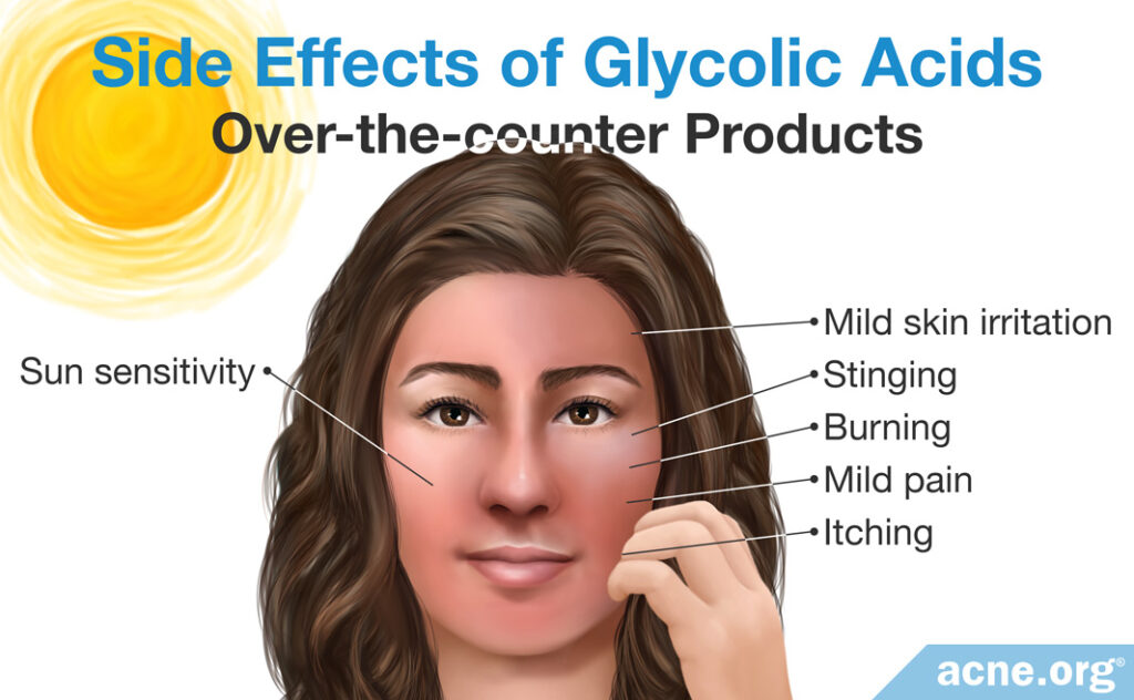 Side Effects of Over-the-counter Glycolic Acid Products
