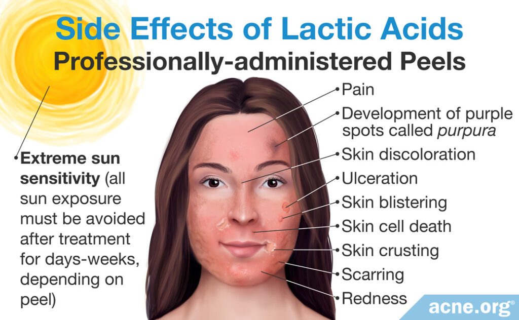 Side Effects of Professionally-administered Lactic Acid Peels