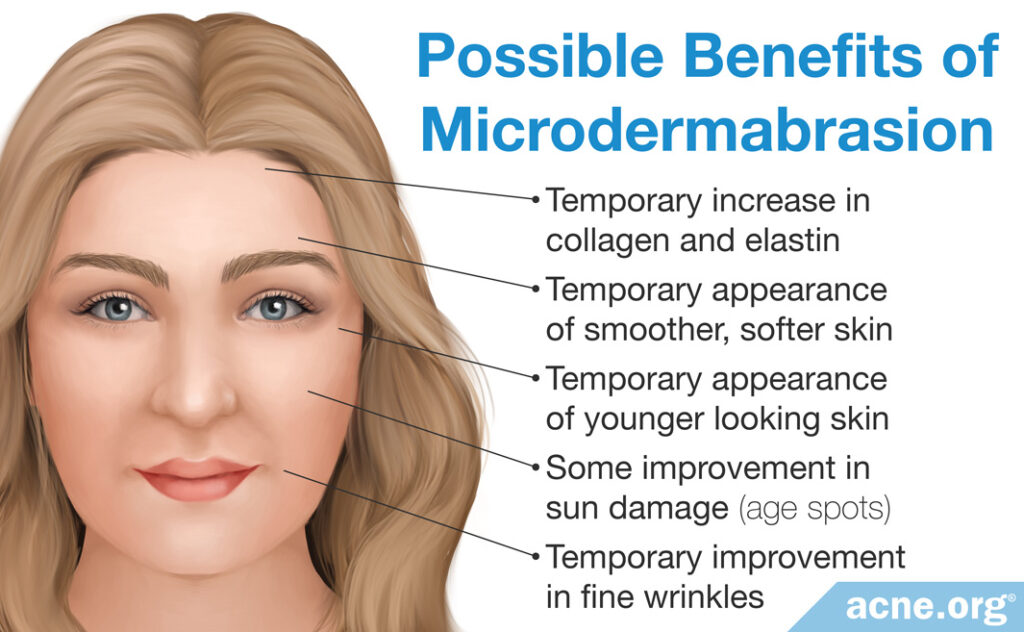 Possible Benefits of Microdermabrasion