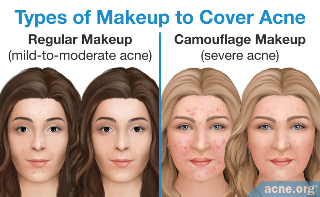 Types of Makeup to Cover Acne