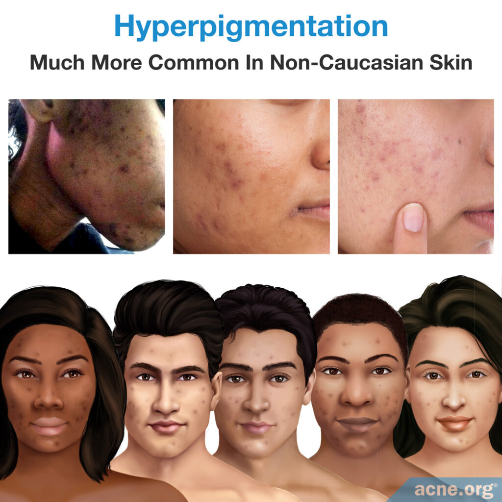 Hyperpigmentation is much more common in non-caucasian skin