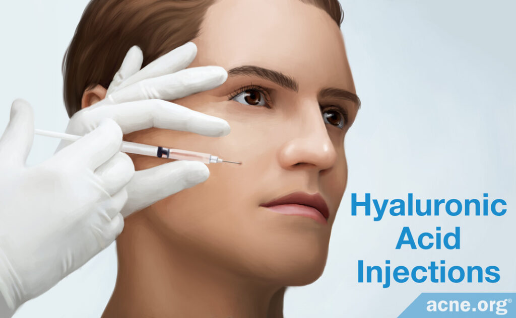 Hyaluronic Acid Injections for Enlarged Pores