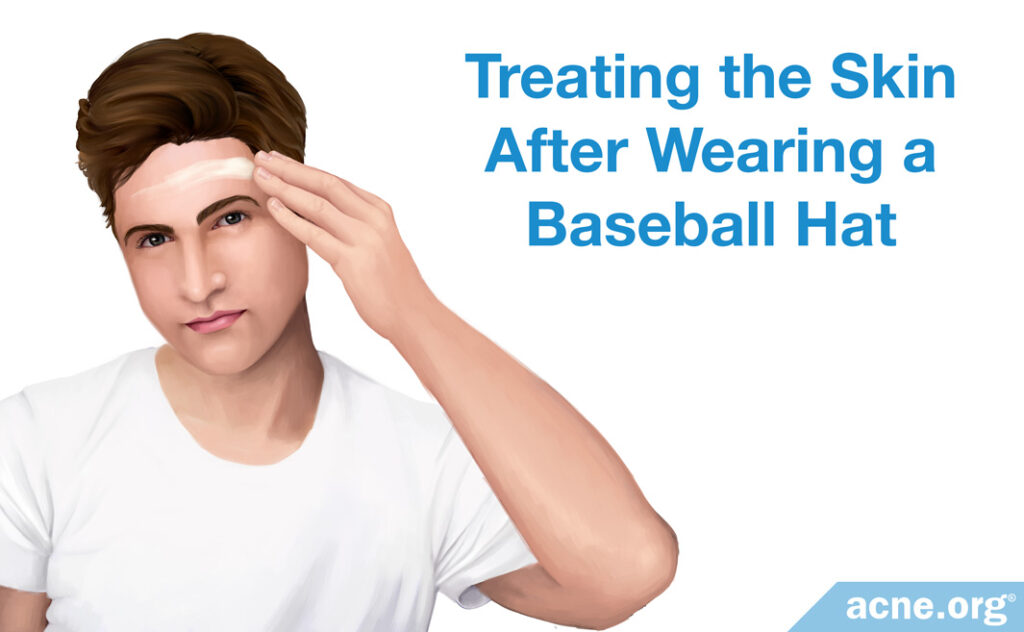 Treating the Skin After Wearing a Baseball Hat