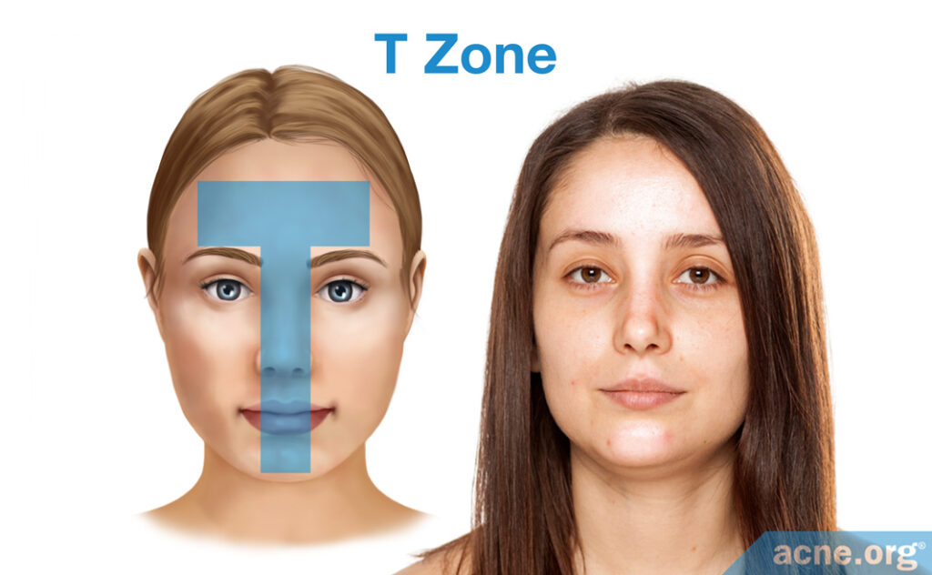 Sebum and the T-zone