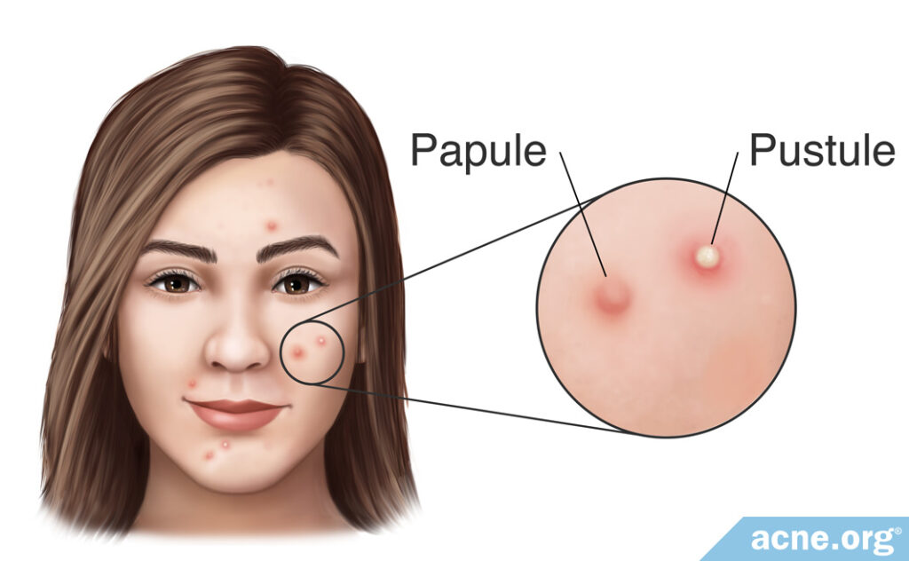 Papule vs. Pustule