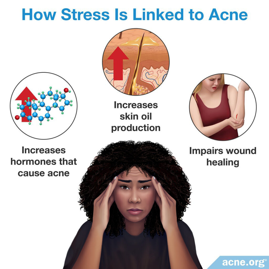 How Stress is Linked to Acne