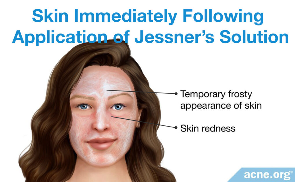 How Does Jessner's Solution Help Clear Acne?