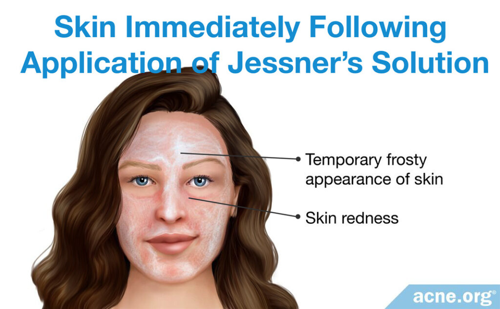 Skin Immediately Following Application of Jessner's Solution