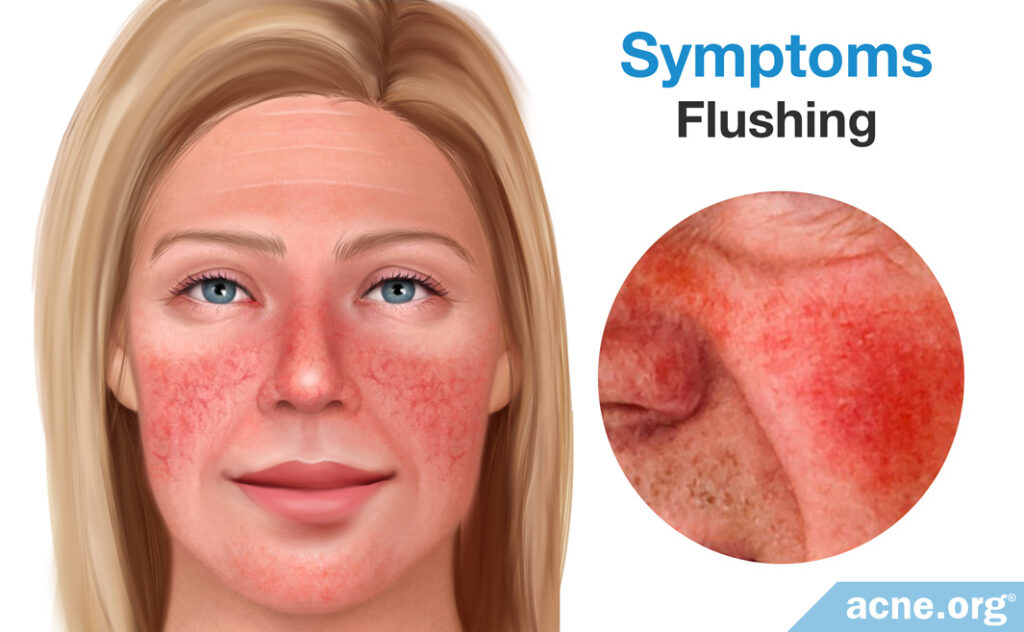 Rosacea Symptoms: Flushing