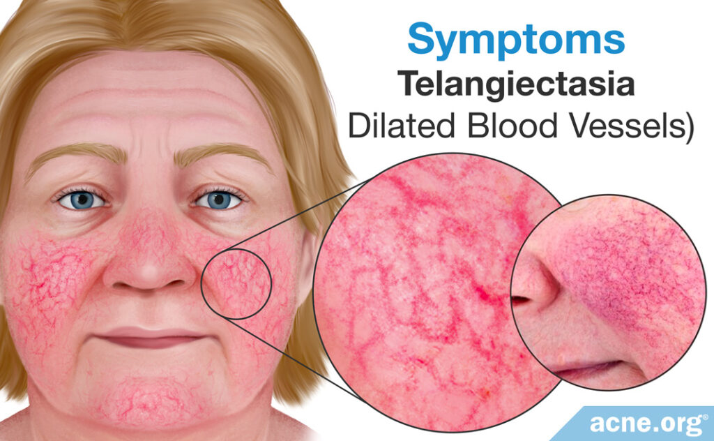 Rosacea Symptoms: Dilated Blood Vessels