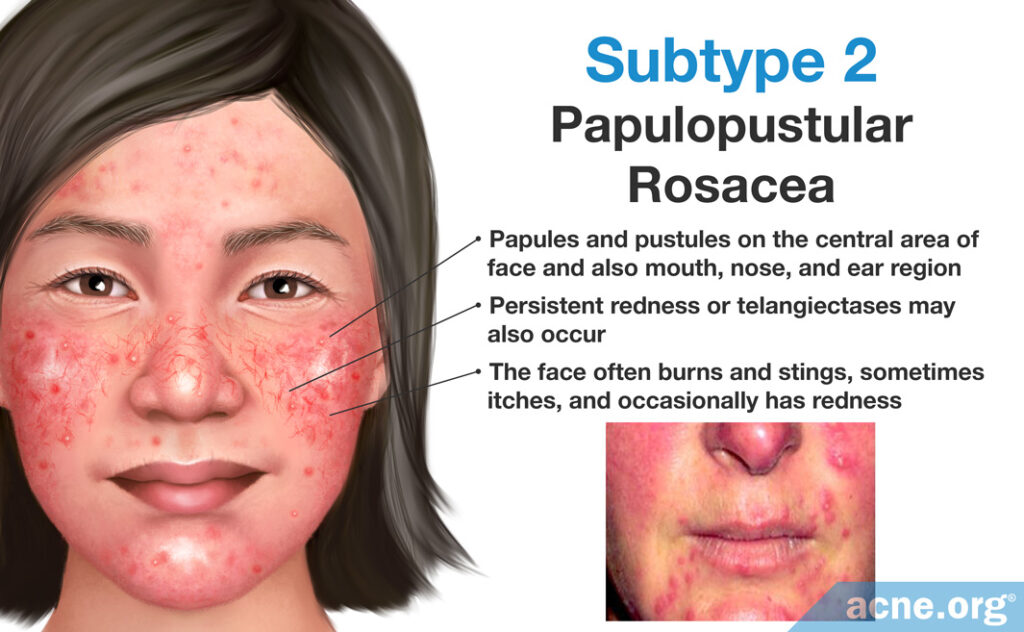 Subtype 2: Papulopustular Rosacea