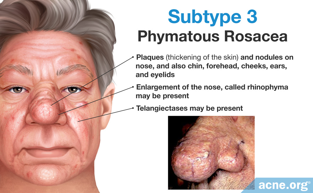 Subtype 3: Phymatous Rosacea