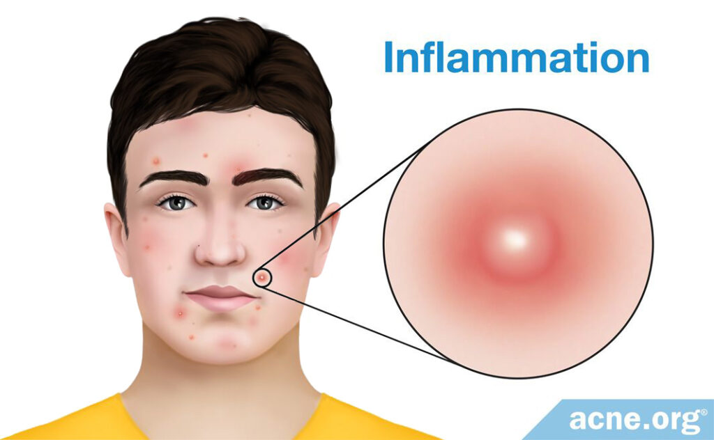 Inflammation