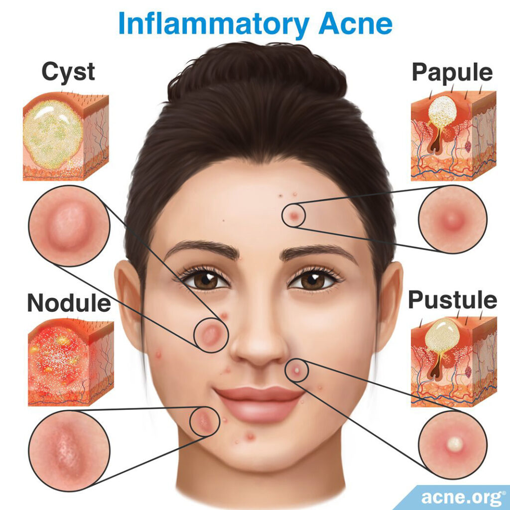 Inflammatory Acne